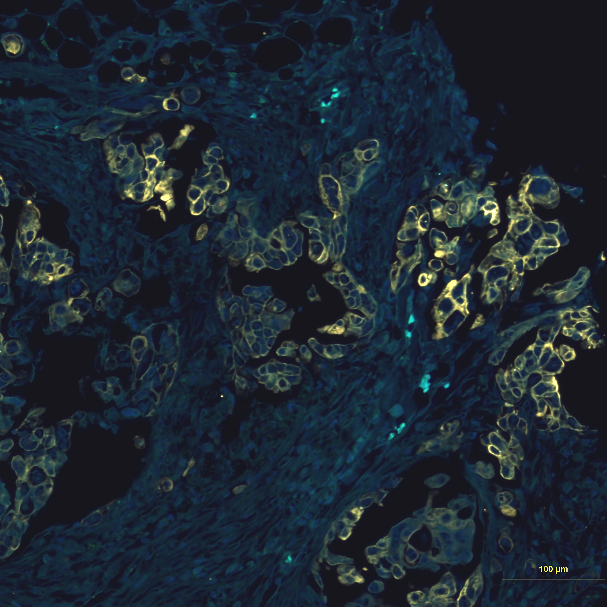 GSTT1 and pFGFR3 staining in metastatic pancreatic cancer tissue
